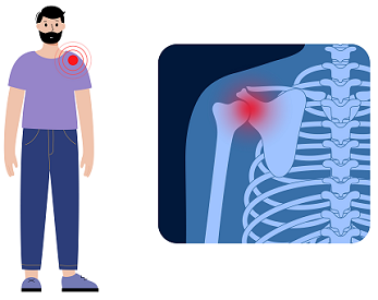 Frozen Shoulder Physiotherapy